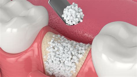 Bone Grafting .